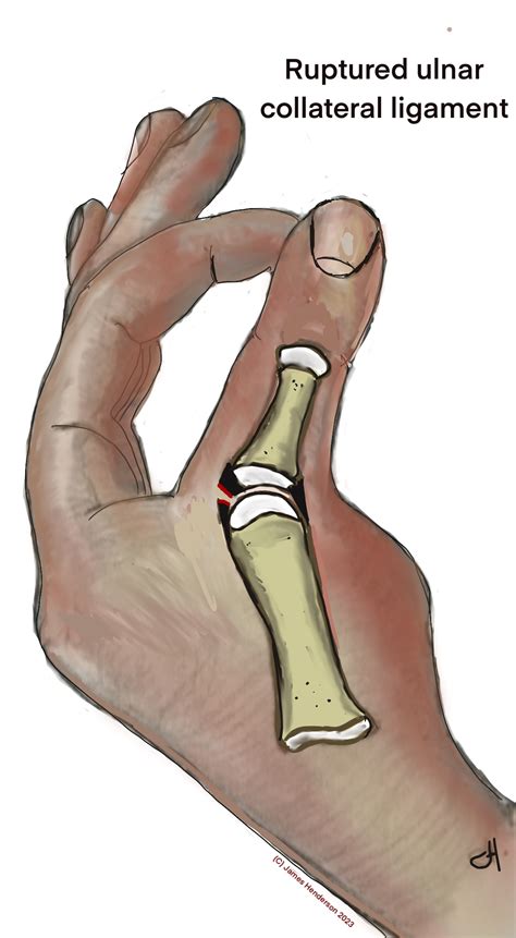 ruptured Ulnar collateral ligament of the thumb metacarpophalangeal ...