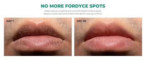 amazoncom abera fordyce cream advanced formula  hpr  gen