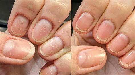 Nail fold question... 6 weeks in : r/calmhands