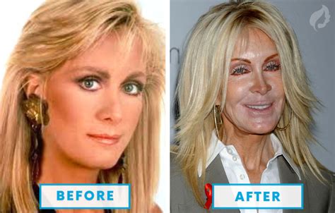 Top 10 Botched Plastic Surgery Fails Before And After - vrogue.co