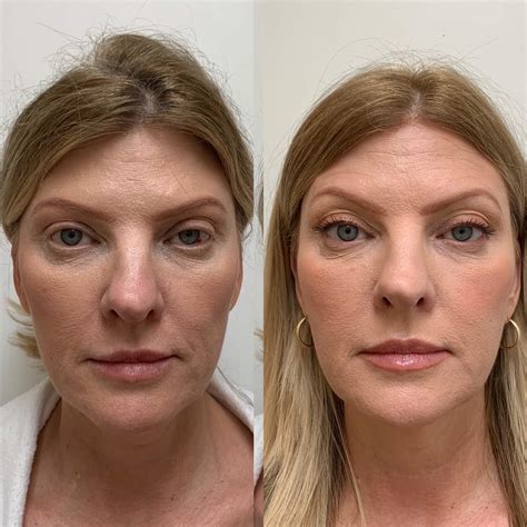 Sculptra Before & After Images | Medspa in Newport Beach, CA