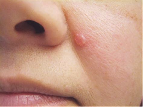 The Most Common Skin Cancer: Basal Cell Carcinoma – Skin Cancer Diagnosis