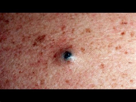 Removes acne - Давим прыщи, чёрные точки. Залипательно 2021 - YouTube