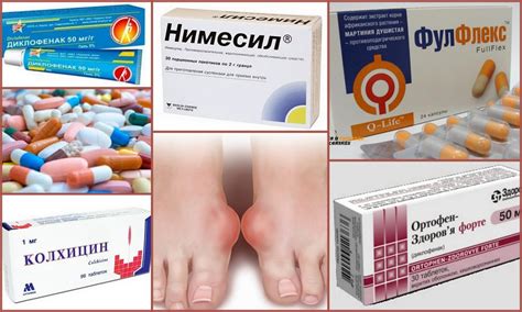 Эффективные лекарства от подагры при обострении
