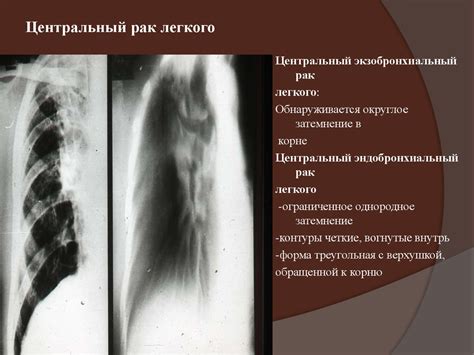 Лучевая диагностика заболеваний органов дыхания - презентация онлайн