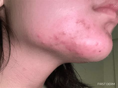 dermatitis  chin perioral dermatitis  symptoms