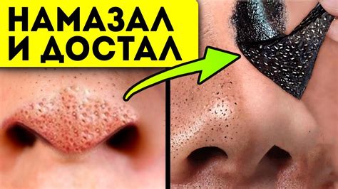 Как быстро удалить черные точки на носу дома? Угри, прыщи, забитые поры ...