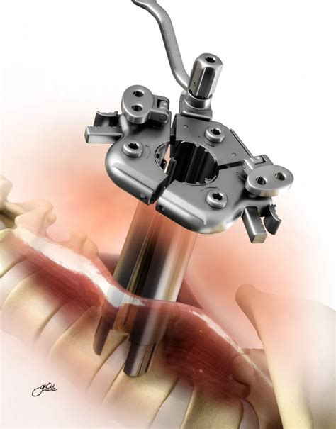 DePuy Spine Device | Image