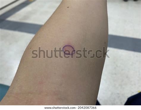 Ppd Tuberculosis Images: Browse 61 Stock Photos & Vectors Free Download ...