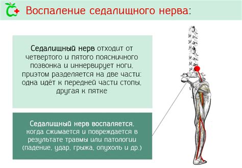 Операция при защемлении седалищного нерва: показания, виды, техника ...