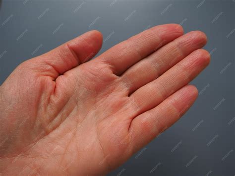 Premium Photo | Female hand with dry atopic skin white background