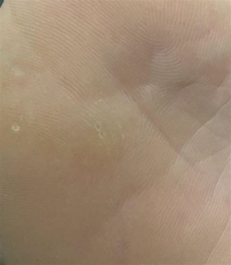 Haven’t had a planter wart since I was a kid and now I’m paranoid I’m