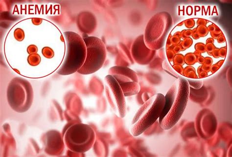 Анемия - Причины, Симптомы, Диагностика и Лечение | Спиженко