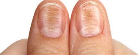 Prevenir y tratar las estrías en las uñas | Blog Druni
