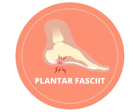 Plantar Fasciit: Symptom, Orsak & Behandling | RunnersGear.se