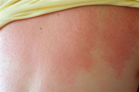 Heat Rash Causes Symptoms Treatments Heat Rash Rash Causes Heat - Riset