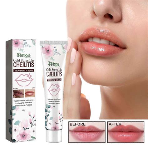 Lip Herpes And Cheilitis Cream, Effectively Nourishes Lips, And