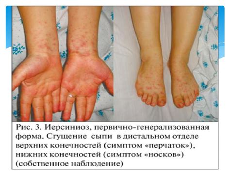 ЭКЗАНТЕМЫ
