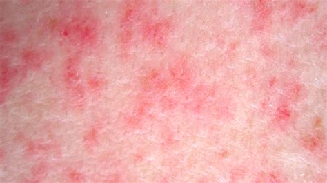 Petechiae Leukemia Symptoms Blog