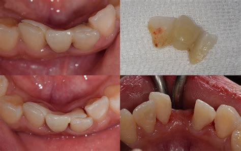 failure   resin bonded  ceramic fixed partial denture