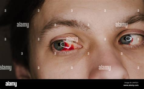 Human eye with subconjunctival hemorrhage showing visible red blood ...