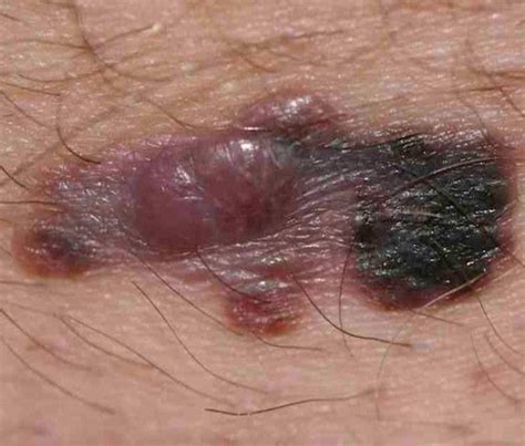 Nodular Melanoma