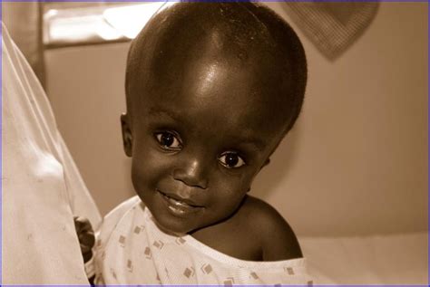 Hydrocephalus Baby Before And After