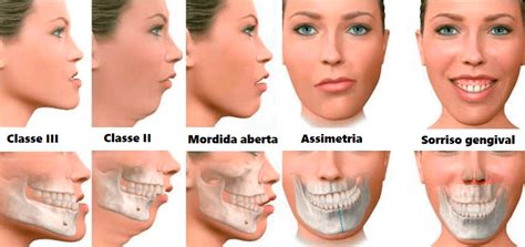 preenchimento  queixo clinica bella pelle