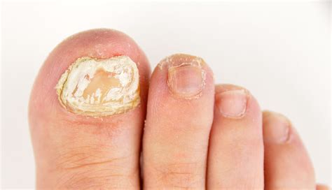 Fungal nails, routine nail care, athletes foot, dermatology | Bexley ...