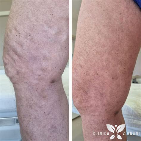 Tratamento De Varizes A Laser Antes E Depois - Endolaser de varizes: veja o antes e depois do tratamento - Clinica Zignani