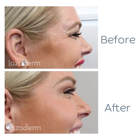 Botox Before And After