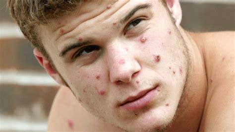 Concerns grow worldwide as rare Monkeypox virus spreads like wildfire ...