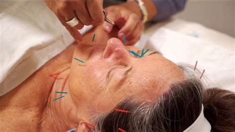 Facial Rejuvenation Acupuncture – Acupuncture Healing Arts