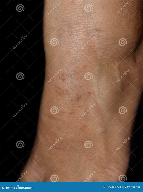 Contagiosum Moluscum Es Parotiditis Benigna O Lesiones En Las Capas