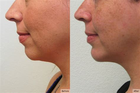 case  neck liposculpting cases face   photo