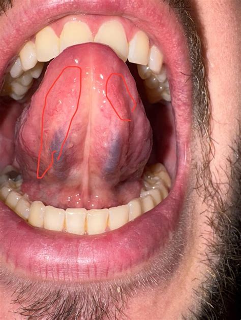 redness  tongue   counter supplements  burning mouth