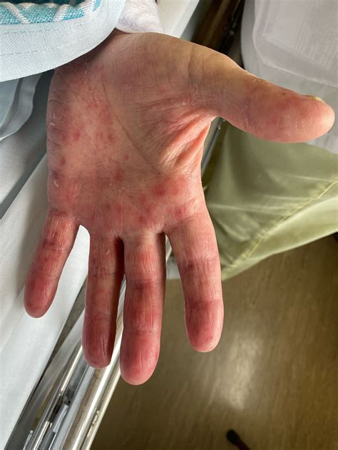 Janeway Lesions