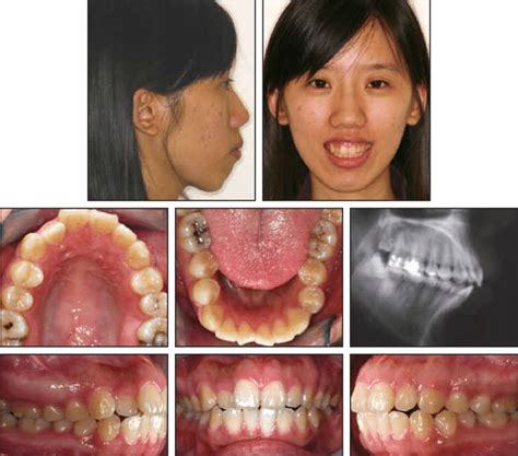 case   year  female patient  protrusive profile