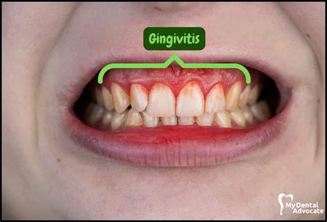 Gingivitis Vine at Andrew Gillan blog