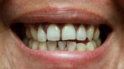 Effective Ways to Remove Stains Between Teeth at Home