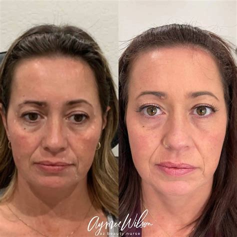 Botox/Dysport/Daxxify Injectables in Prescott Valley, AZ