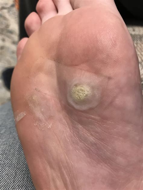 216 best Plantar Wart images on Pholder | Warts, Peeling and Dermatology