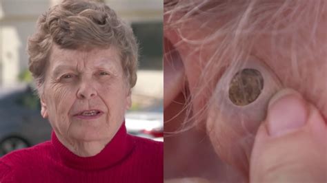 Dr Pimple Popper Blackhead Extraction Pops at William Frazier blog