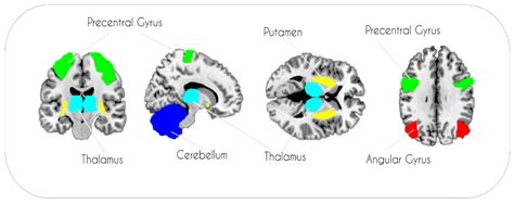 Replication of Previous Findings? Comparing Gray Matter Volumes in