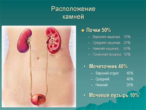 Мочекаменная болезнь - презентация онлайн
