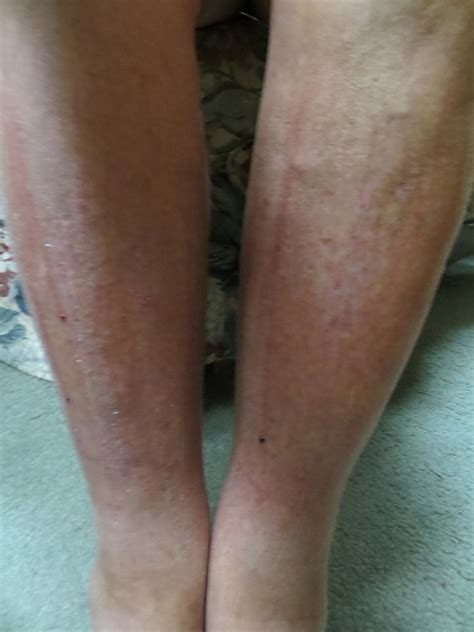 Sore Front Lower Leg at Ruth Buskirk blog