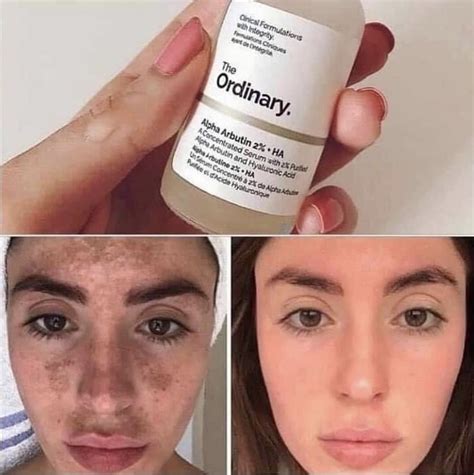 The Ordinary Guide For Hyperpigmentation - Guide BizGuru
