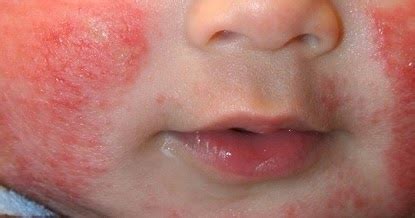 Pele Do Bebê Grossa E Com Carocinhos - CAROÇINHOS NO ROSTO DO BEBÊ, VEJA O QUE PODE SER!