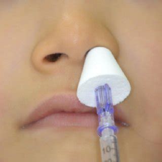 Intranasal spray(LMA MAD Nasal™, Wolfe Tory Medical Inc., USA). Fig. 2.... | Download Scientific ...