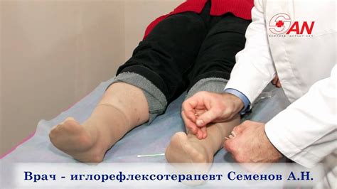 Лечение табакокурения иглоукалыванием. - YouTube